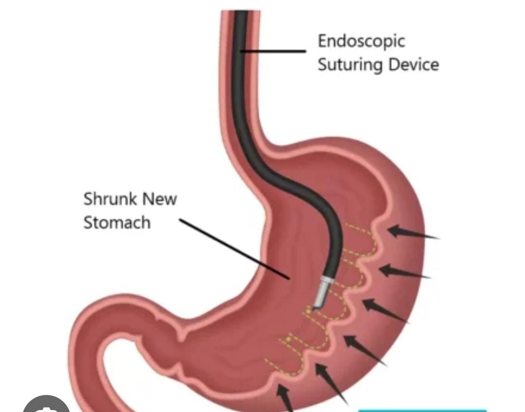 Gastroplastía Endoscópica